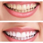 Bieliace pásiky na zuby Advanced teeth whitening